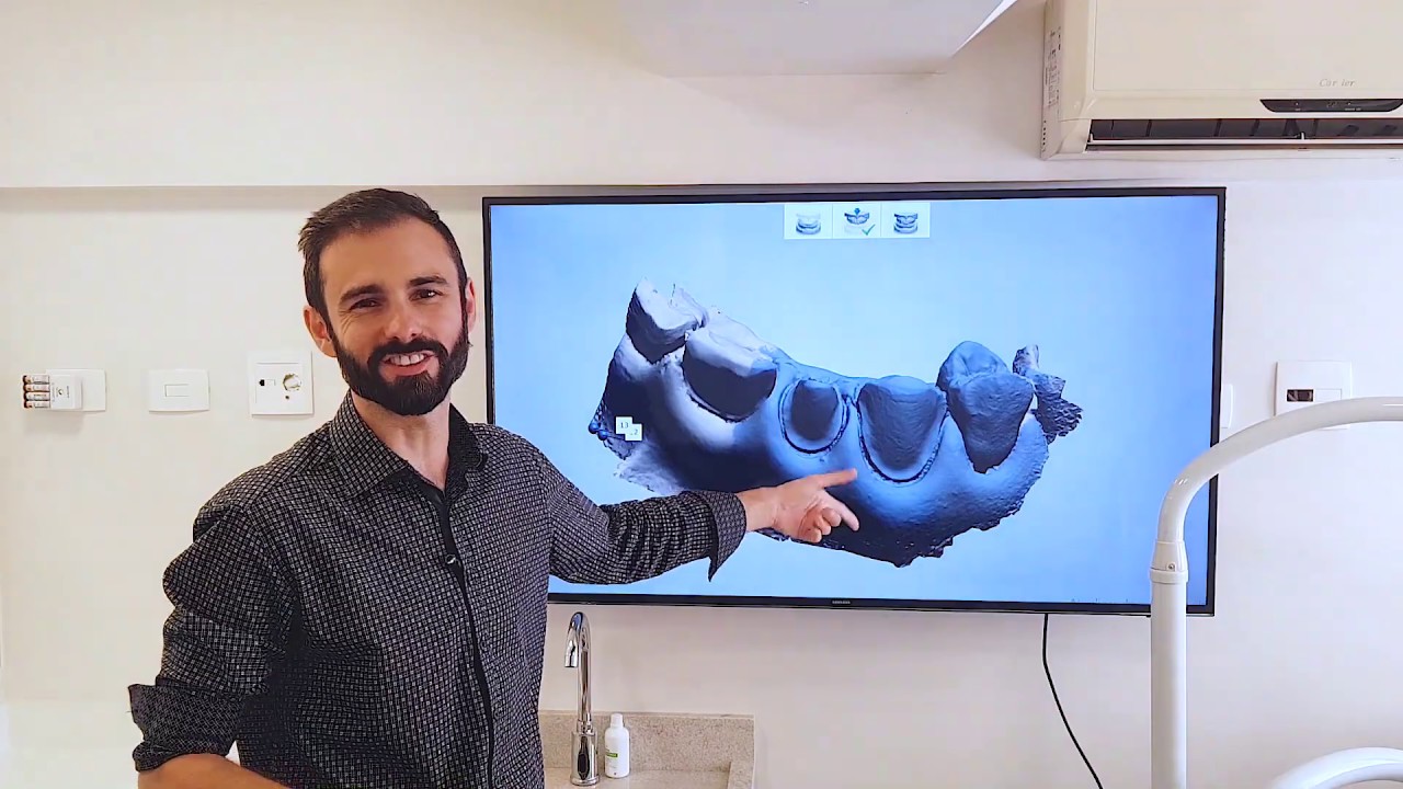 Como escanear preparos subgengivais para prótese no Itero, 3shape, carestream , sirena etc.