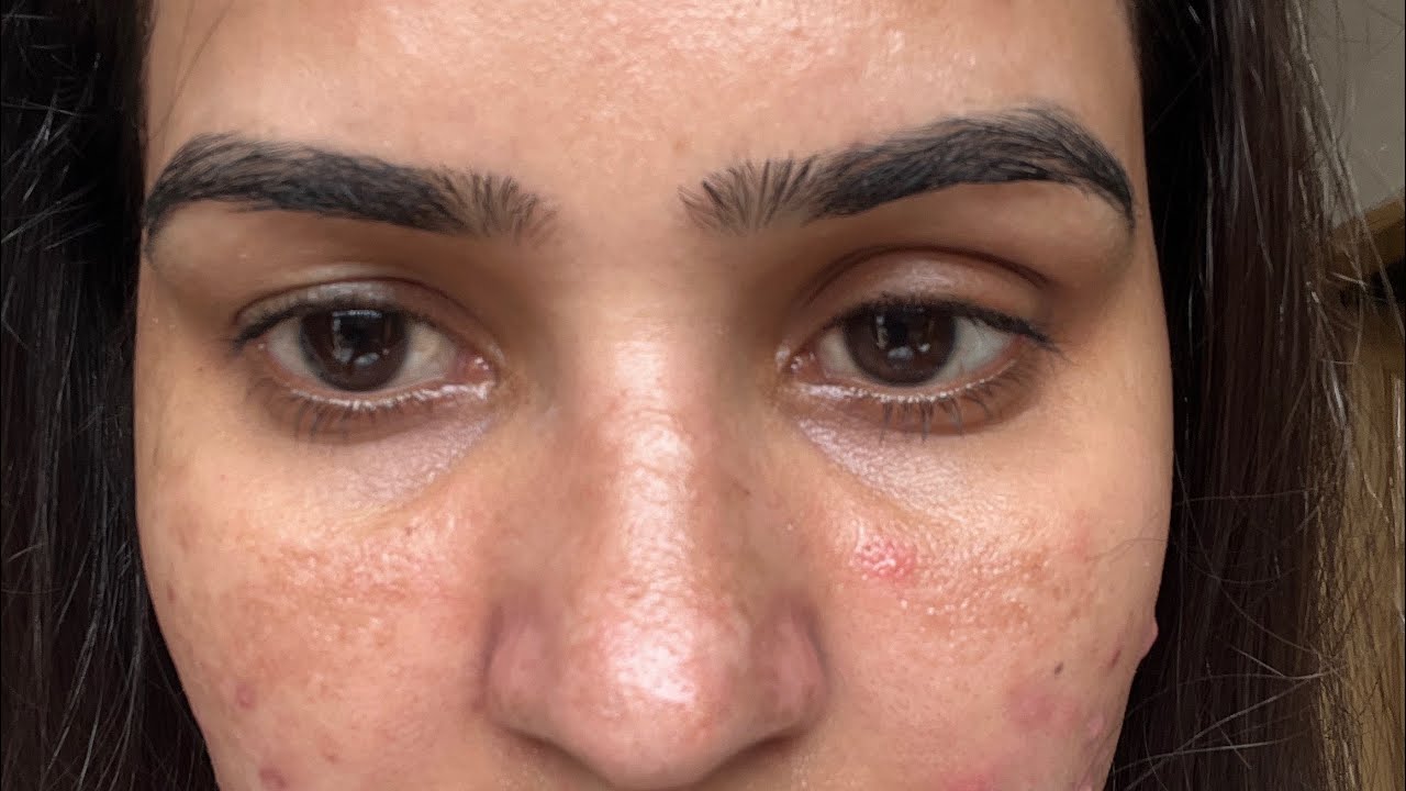 My PM Routine for Acne and Dark Spots — Azelaic Acid Edition