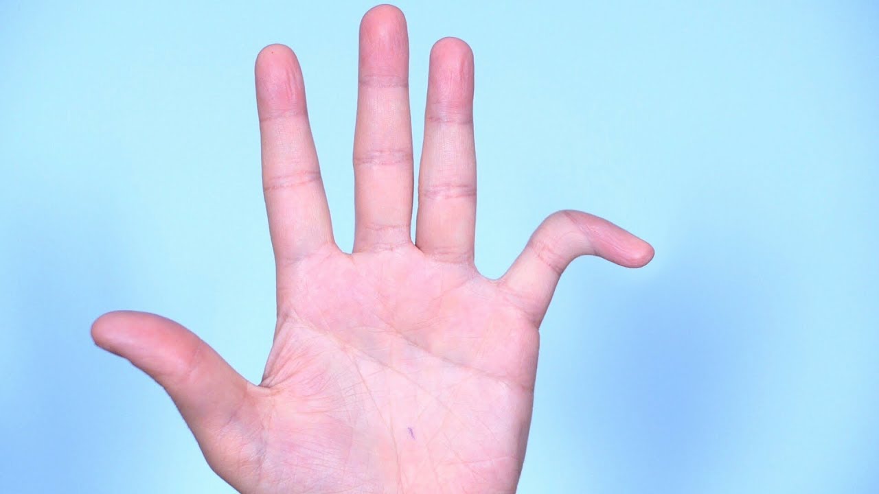 FINGER DISLOCATED!