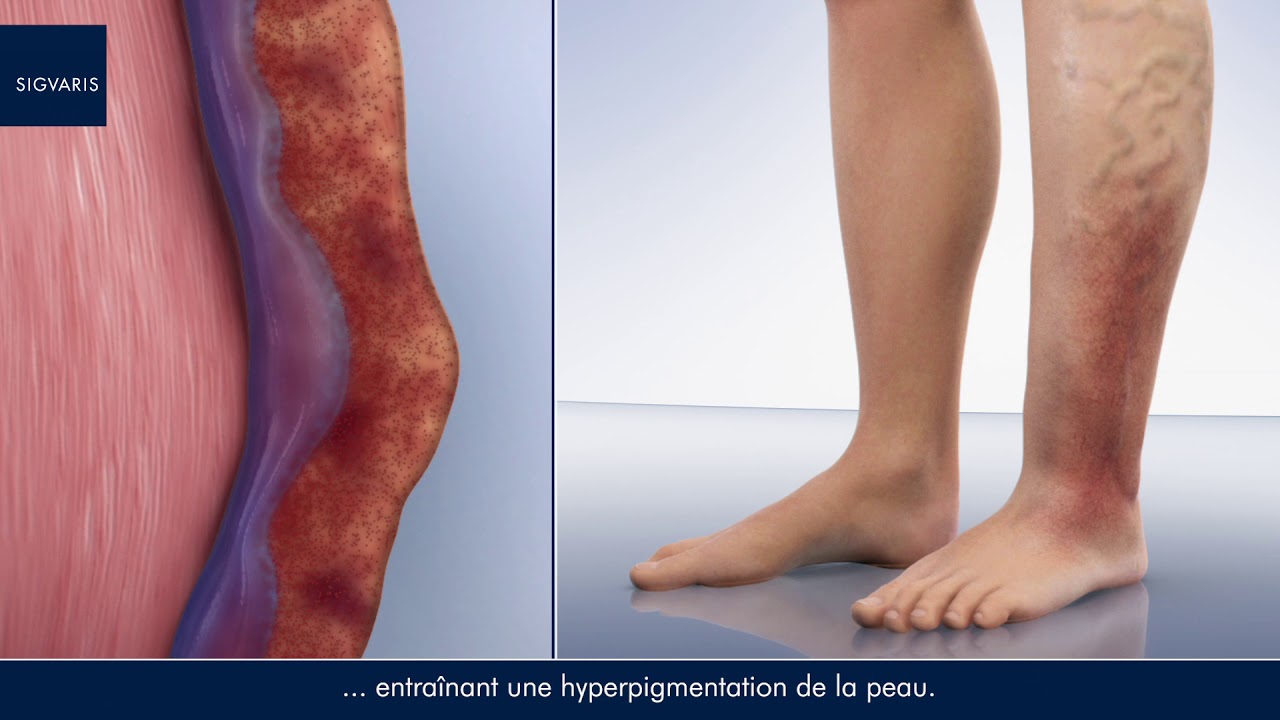 Vidéo d’animation médicale sur l’insuffisance veineuse