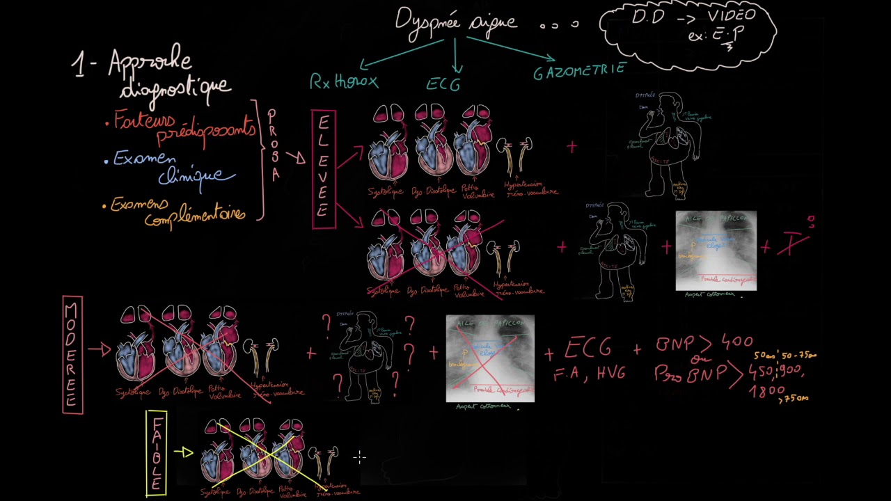 Insuffisance cardiaque aiguë en 3 étapes - Partie 1 - Docteur Synapse