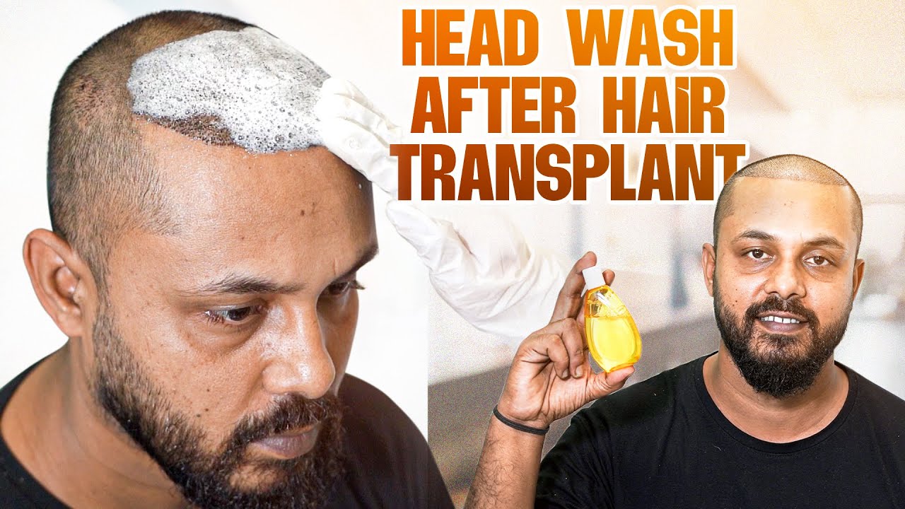 How to Wash Your Hair Without Damaging Grafts? 🧐 | Hair Transplant Kolkata | New Roots