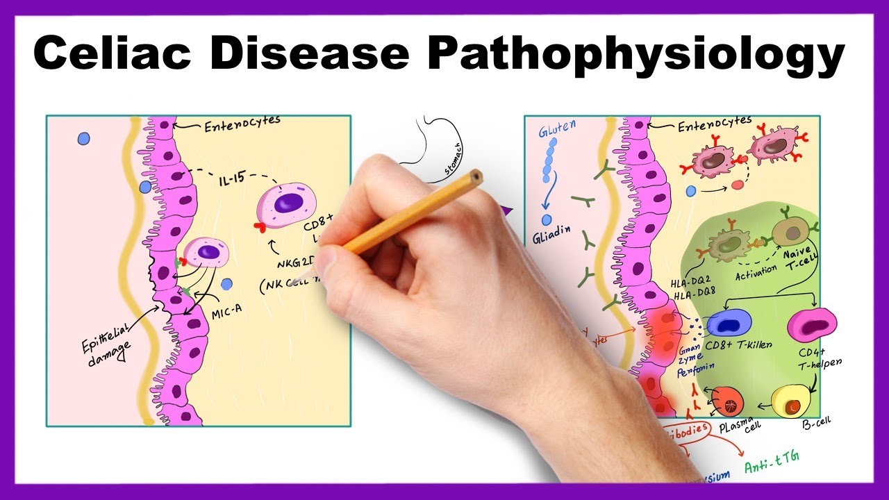 Celiac Disease Pathophysiology Simplified