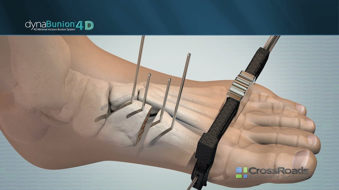 DynaBunion® 4D Minimal-Incision Lapidus System - Featuring Gen 2 Instruments