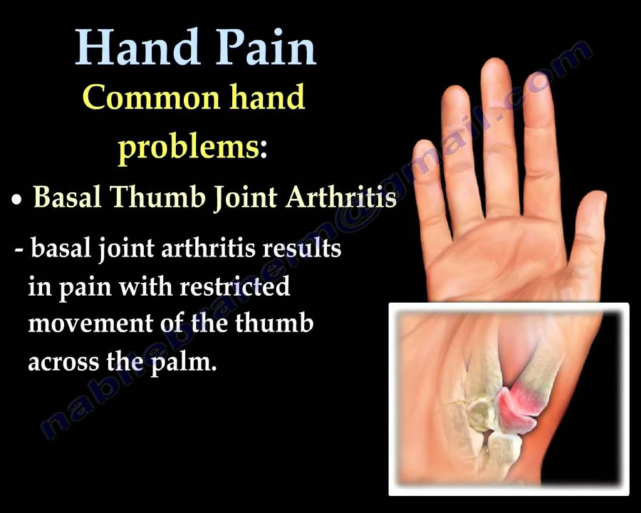 Hand Pain ,Fingers pain - Everything You Need To Know - Dr. Nabil Ebraheim