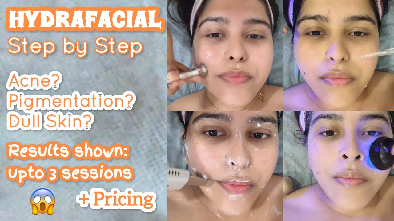 HYDRAFACIAL: Step-by-Step | Is this WORTH it? (Before & After Results) + Pricing