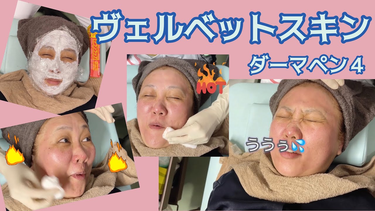 【アラフィフの挑戦】✨ヴェルベットスキン✨ダウンタイム報告も有り🥰