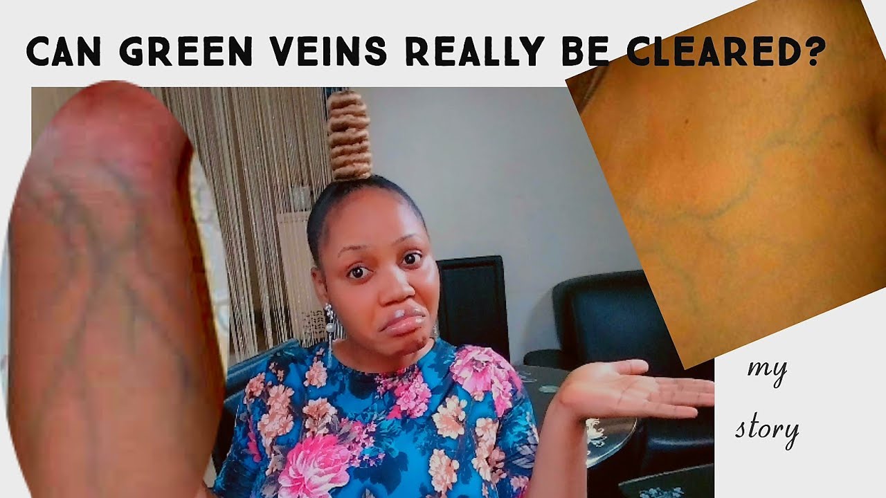 Pro tips on How I Cleared off all my GREEN VEINS naturally_From cause to solution
