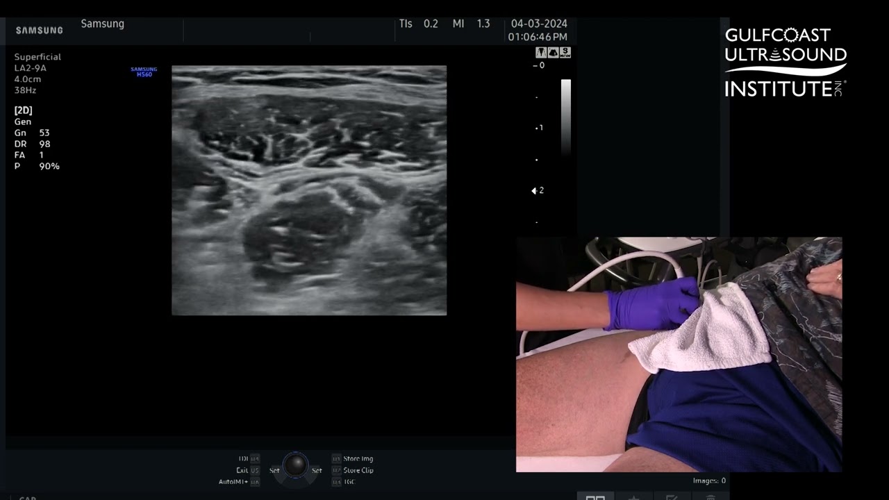 How to Perform an Ultrasound Guided Fascia Iliaca Plane Block