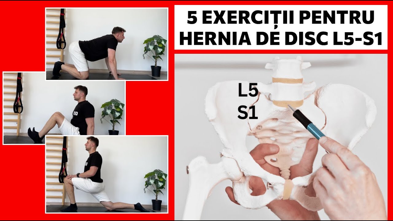 5 exerciții pentru hernia de disc L5-S1 | KINETOTERAPIE
