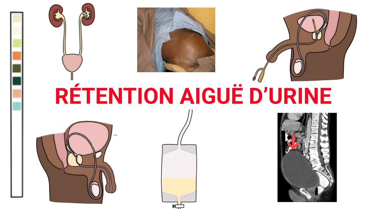 La Rétention aiguë d’urine : physiopathologie, symptômes, diagnostic, traitement