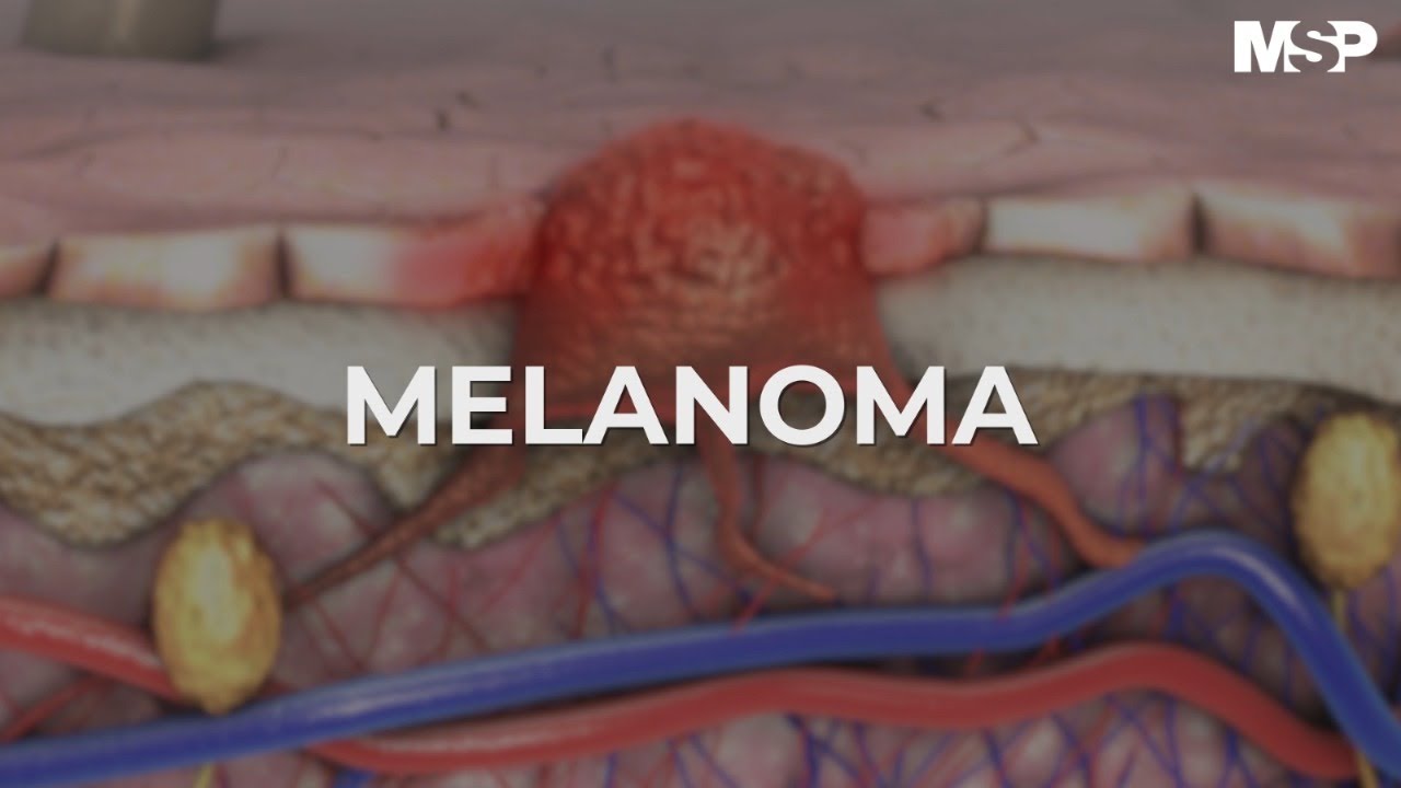 Melanoma