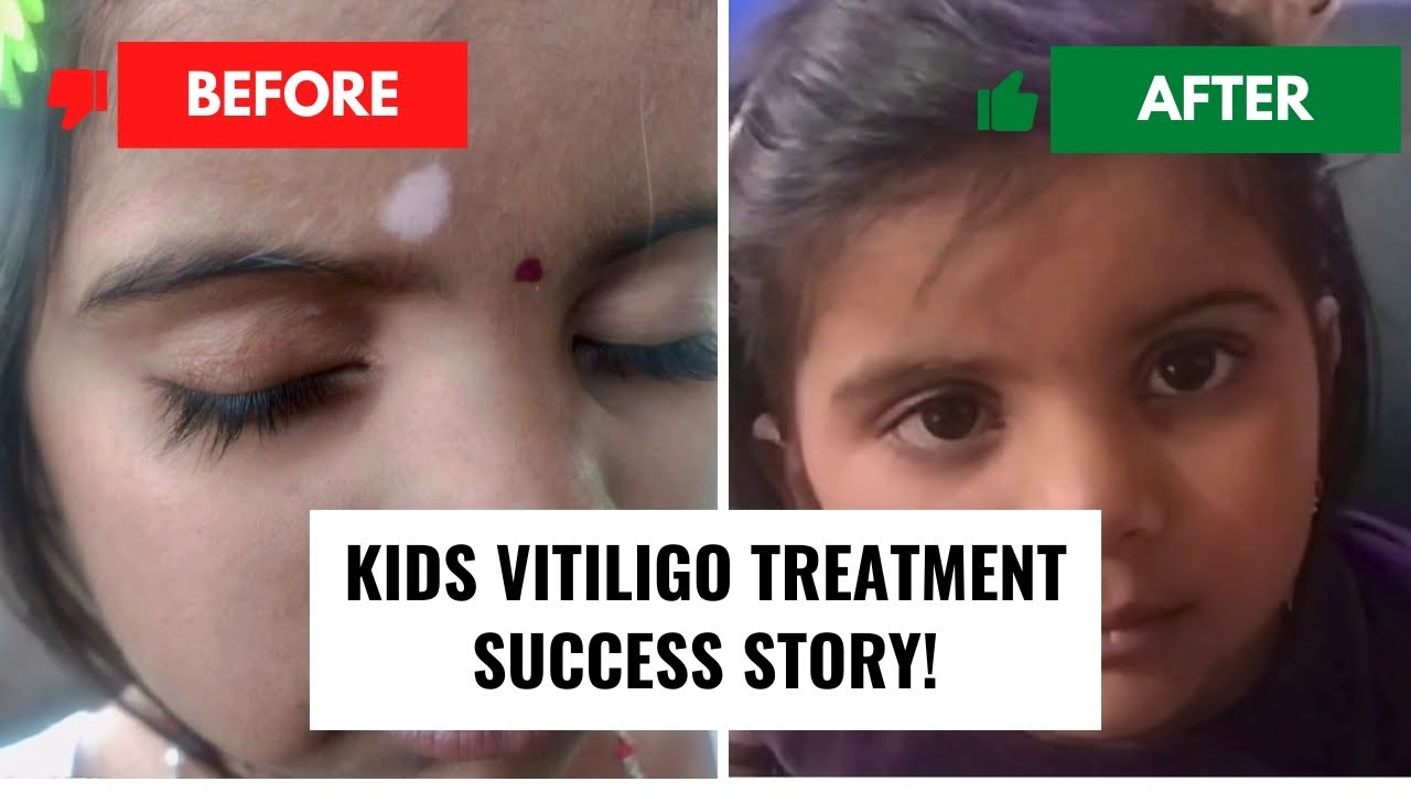 Say Goodbye to White Patches: Kids Vitiligo Treatment Success Story | Dr Danial's Clinic #ankleshwar