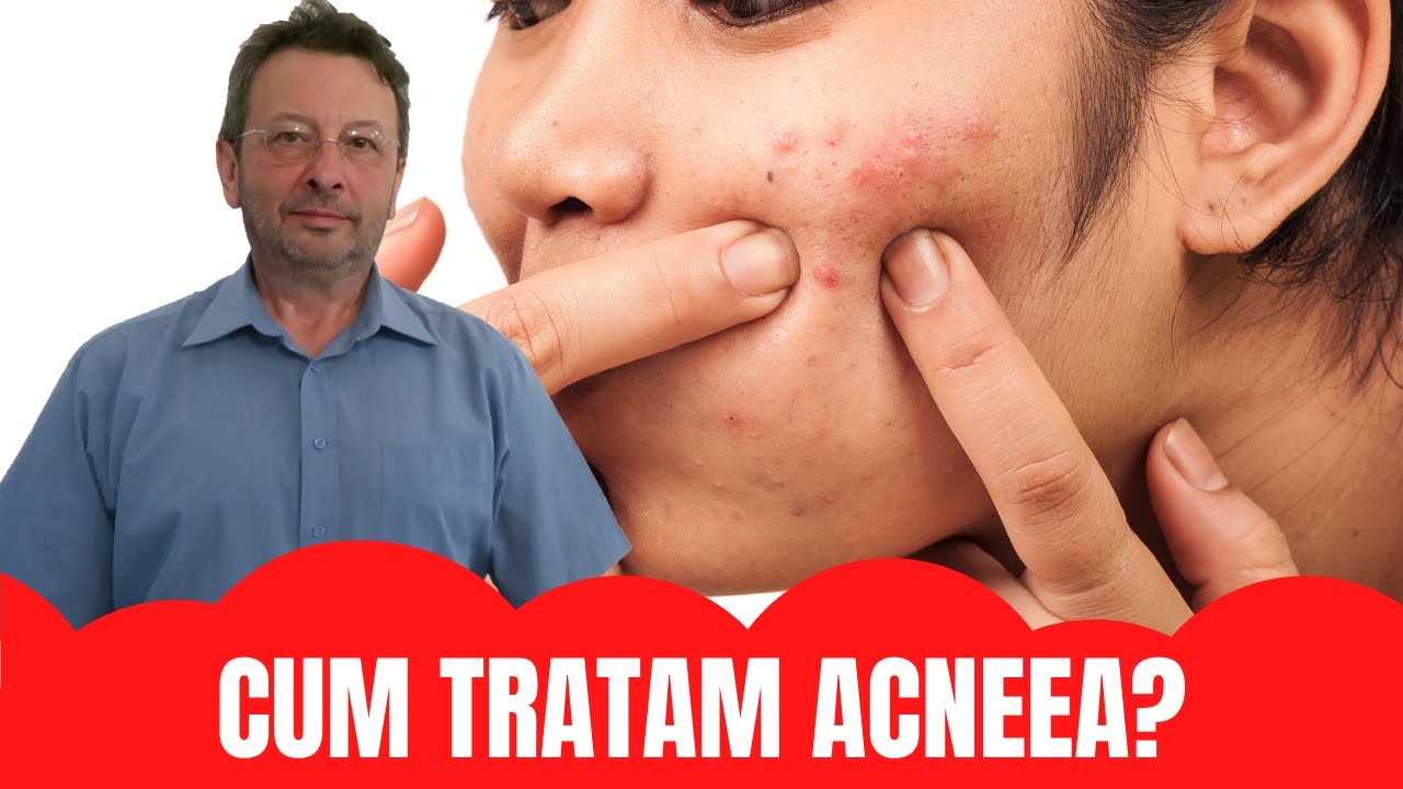 TRATAMENTUL ACNEEI (COSURILOR)