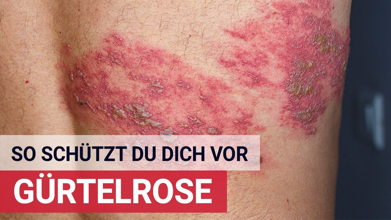 So schützt du dich vor Gürtelrose!