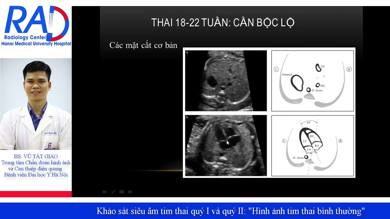 Khảo sát siêu âm tim thai quý I và quý II: 