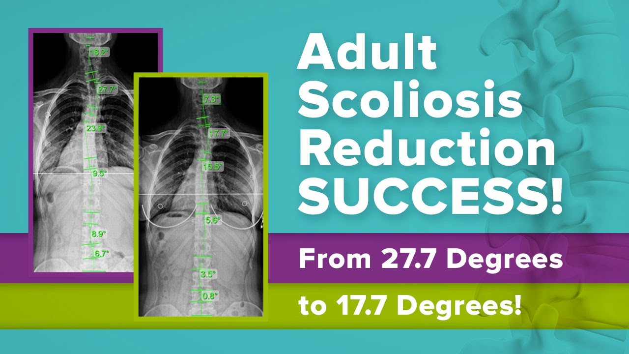 Adult Scoliosis Reduction SUCCESS! From 27.7 Degrees to 17.7 Degrees! (Amber's Story)