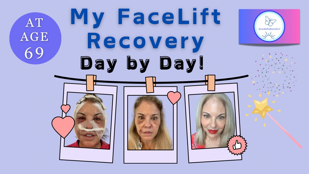 My Facelift Recovery Journey Day by Day~In Pictures!