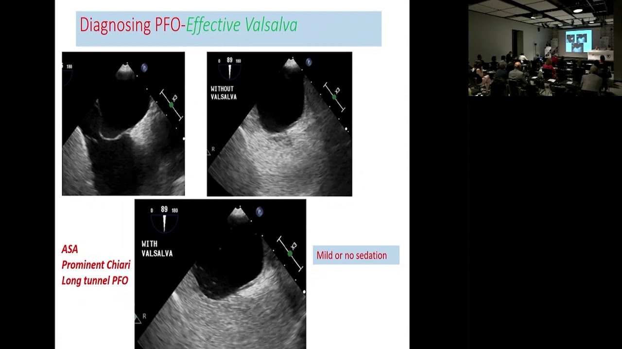 Doç. Dr. Gökhan Kahveci | Patent Foramen Ovale - Echocardiography