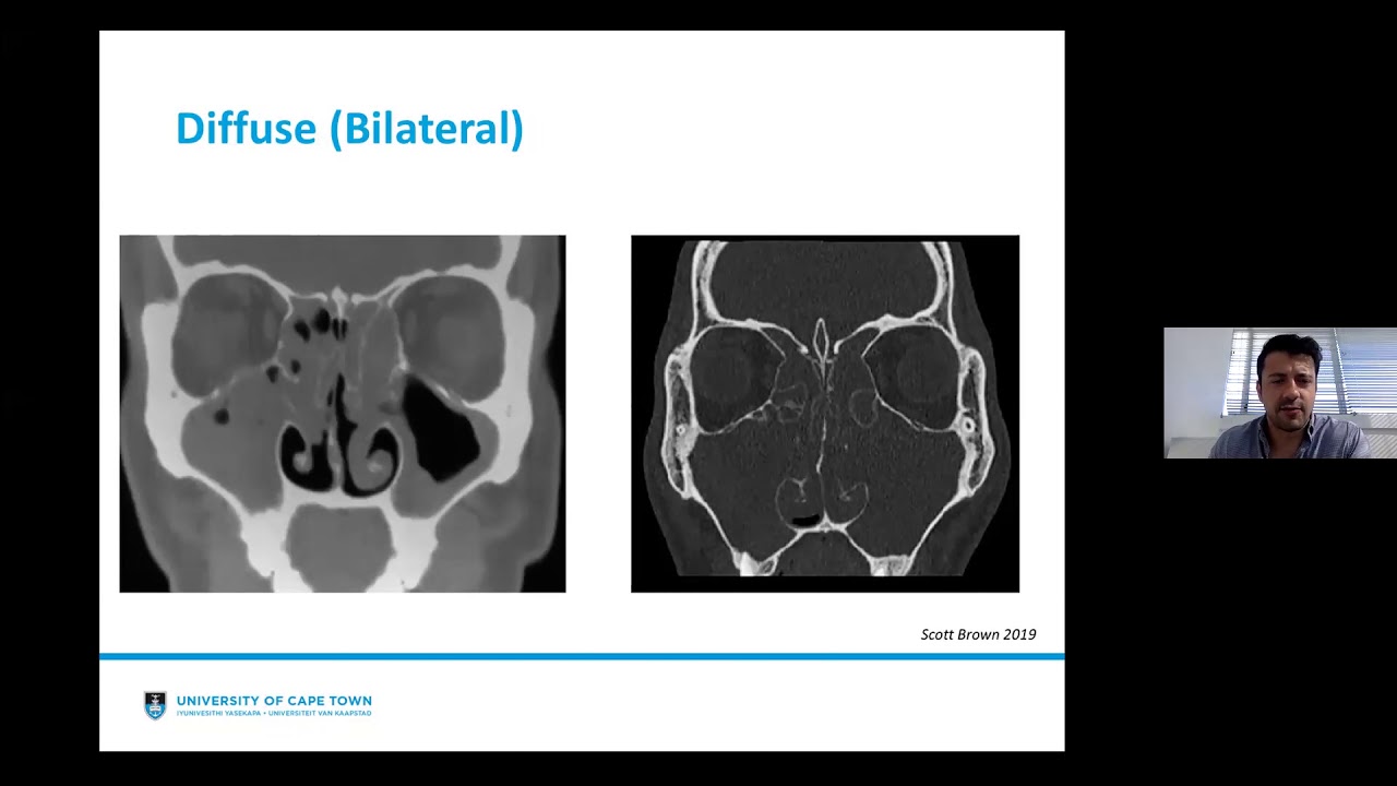 Rhinosinusitis: EPOS 2020 Update