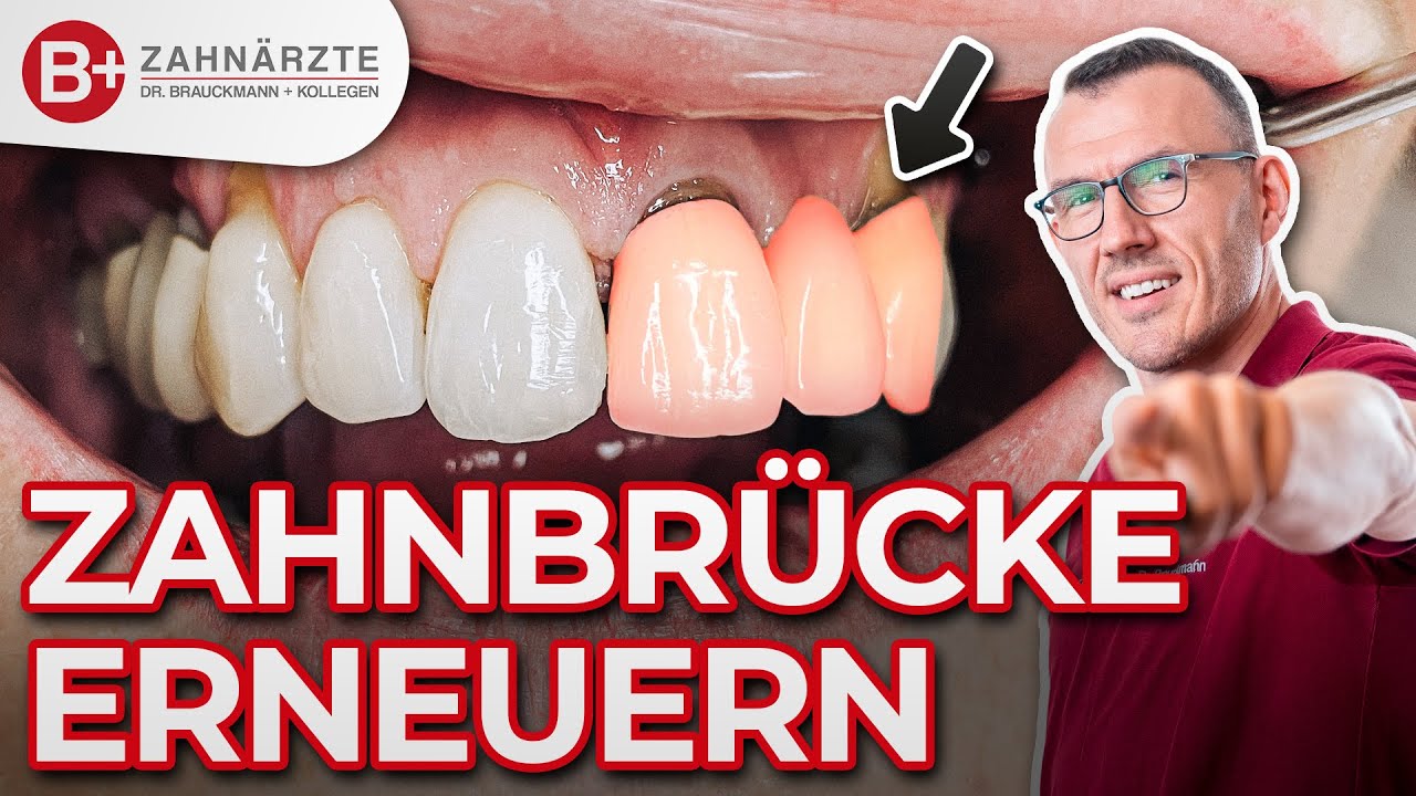 Zahnbrücke für die Frontzähne entfernen und erneuern! Neue schöne Zähne inkl. Vorher-Nachher!