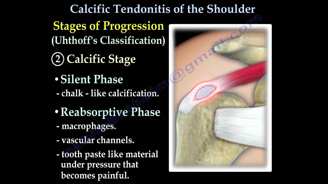 Calcific Tendonitis - Everything You Need To Know - Dr. Nabil Ebraheim
