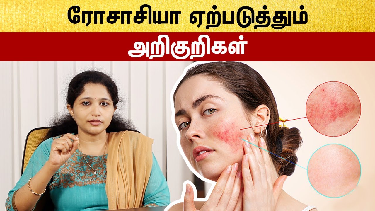 Rosacea Symptoms And Treatment Tamil | முகத்தில் சிவப்பு நிறமான தோல் ஏற்பட காரணம்?