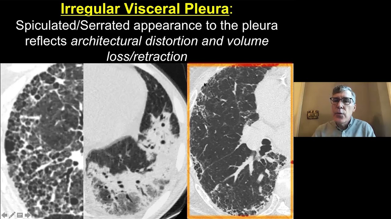 Consolidation and Ground Glass - Imaging Approach to Fibrosis