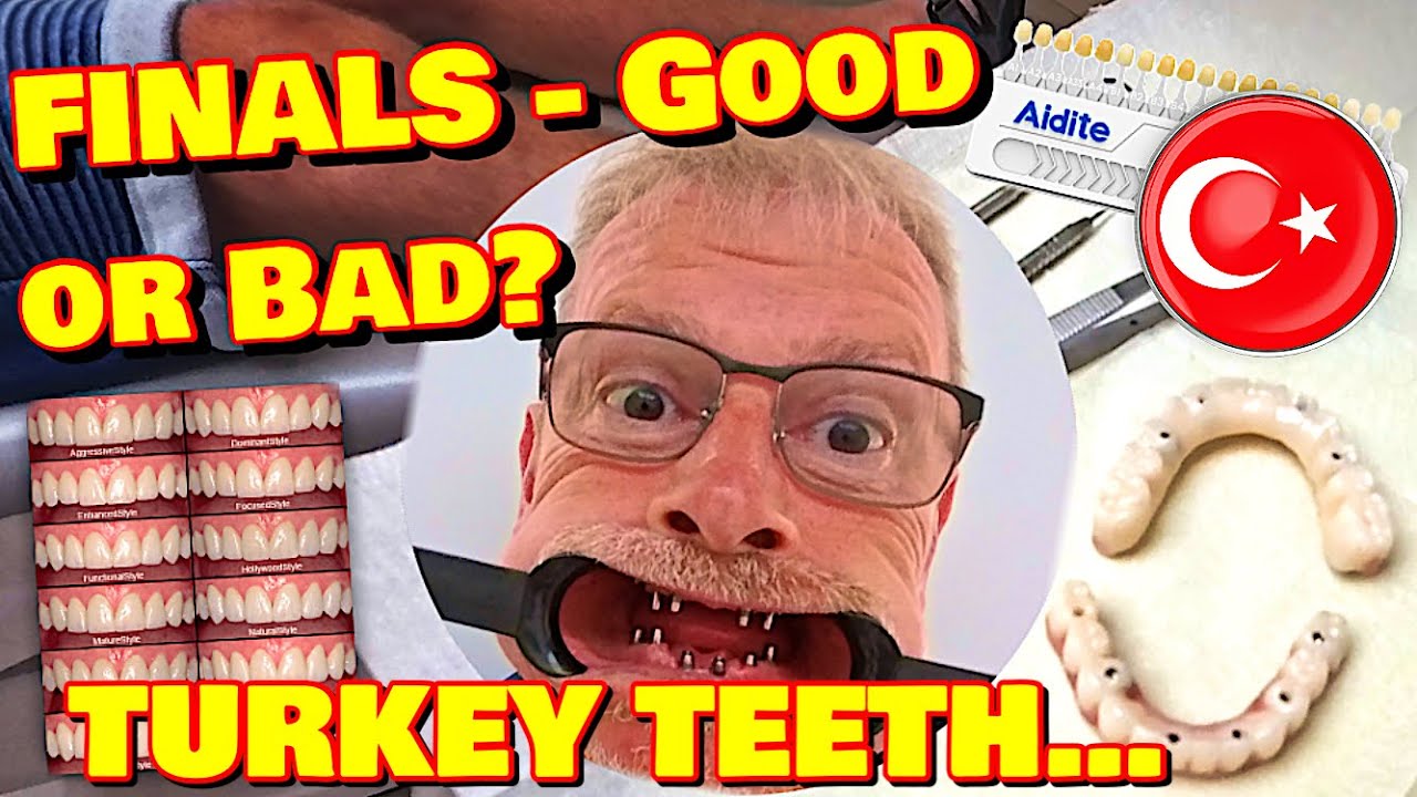 Dental Work in Turkey | Finals Fitted - Life Changer?