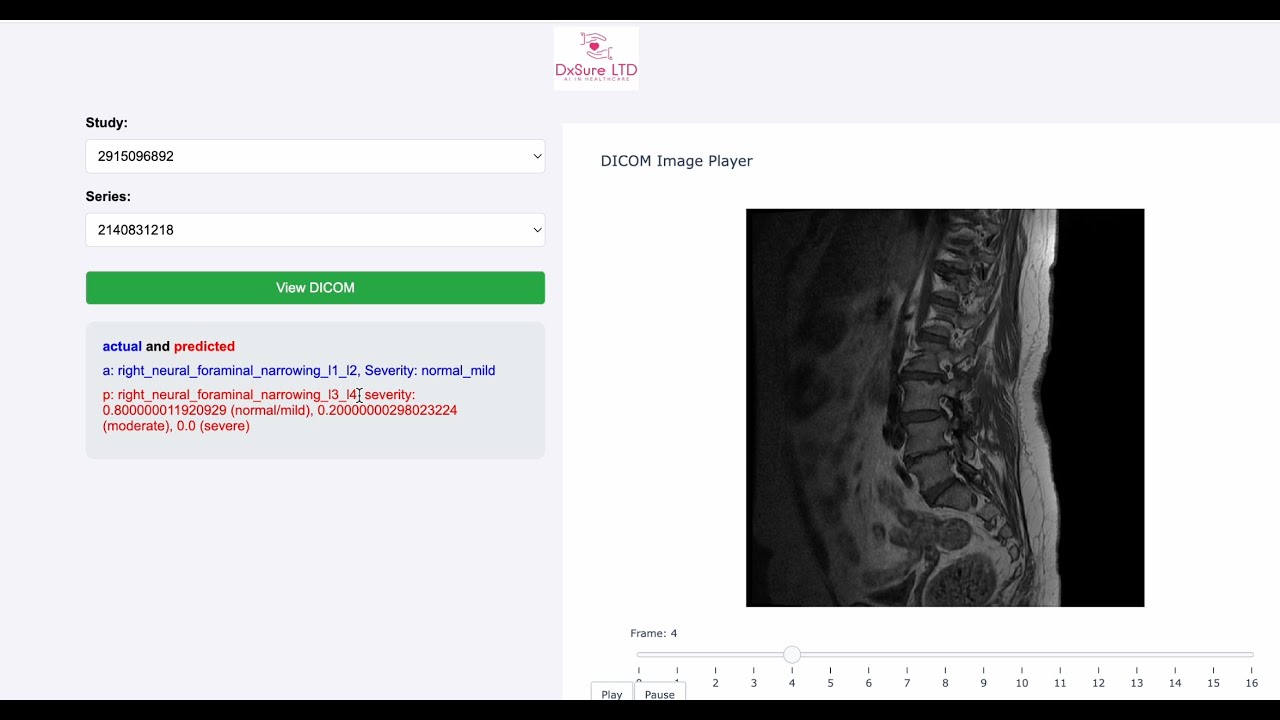 Demo: AI Model to diagnose degenerative conditions affecting the human spine