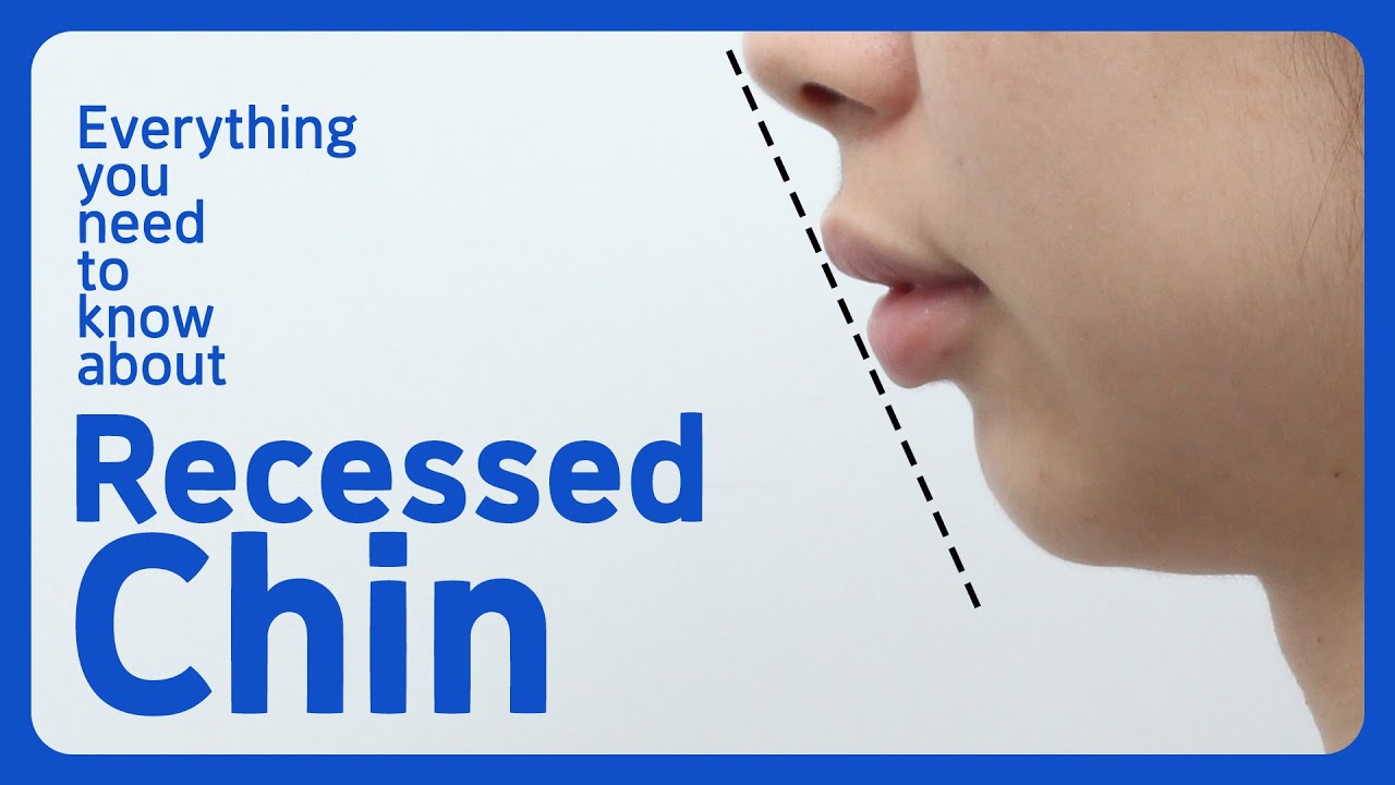 🍭Genioplasty or Chin Implant? Everything about Recessed Chin with Doctor Lee hobin