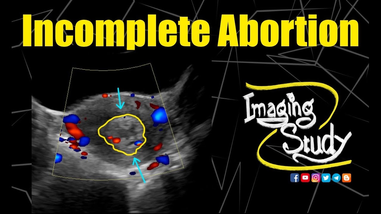 Incomplete Abortion || Ultrasound || Doppler || Case 218