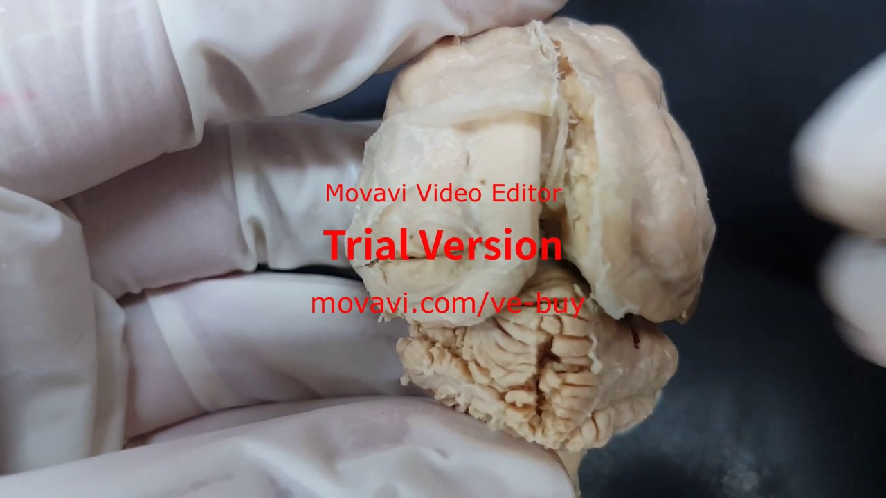 2 Dorsal Aspect of the Brain