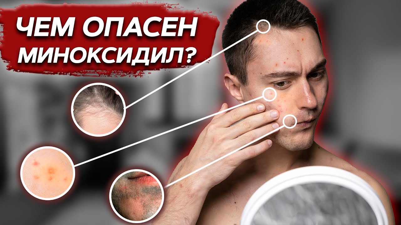 В чем ОПАСНОСТЬ миноксидила? / Что таится в составе миноксидила?