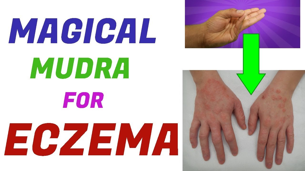 Mudra For Eczema/Hand mudra For Eczema/Eczema Treatment In Hindi Language/Eczema Mudra