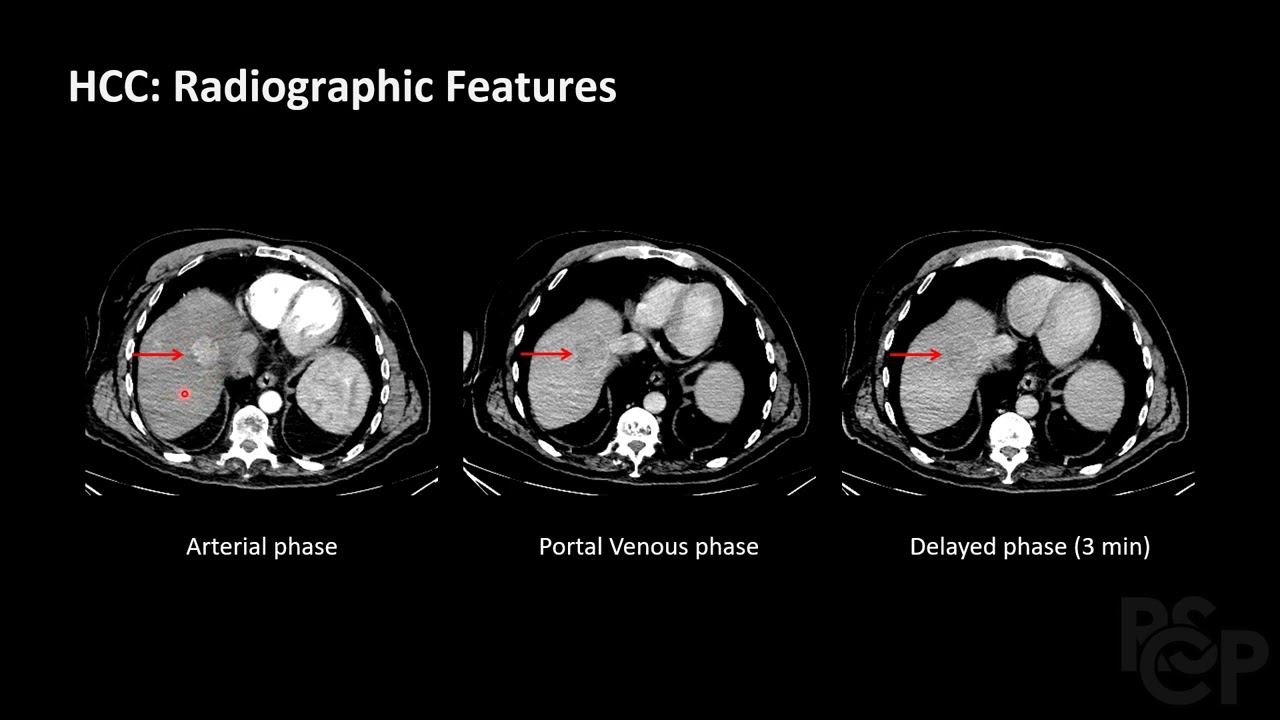 Liver Lesions - RSCP Video Curriculum