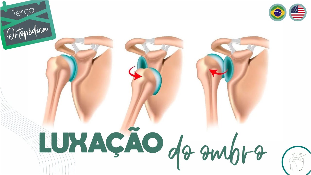 Luxação do Ombro - Instabilidade Glenoumeral  (Ortopedista - Dr. Eric Curi - Ombro e Cotovelo)