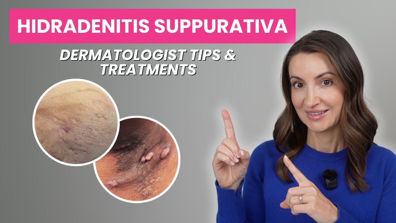Hidradenitis Suppurativa: Symptoms, Causes, and Treatments Explained by a Dermatologist