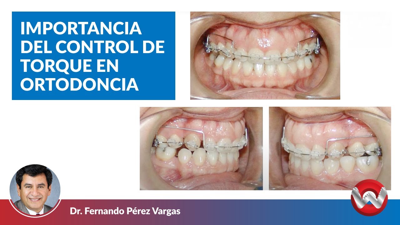 Importancia del Control de Torque en Ortodoncia