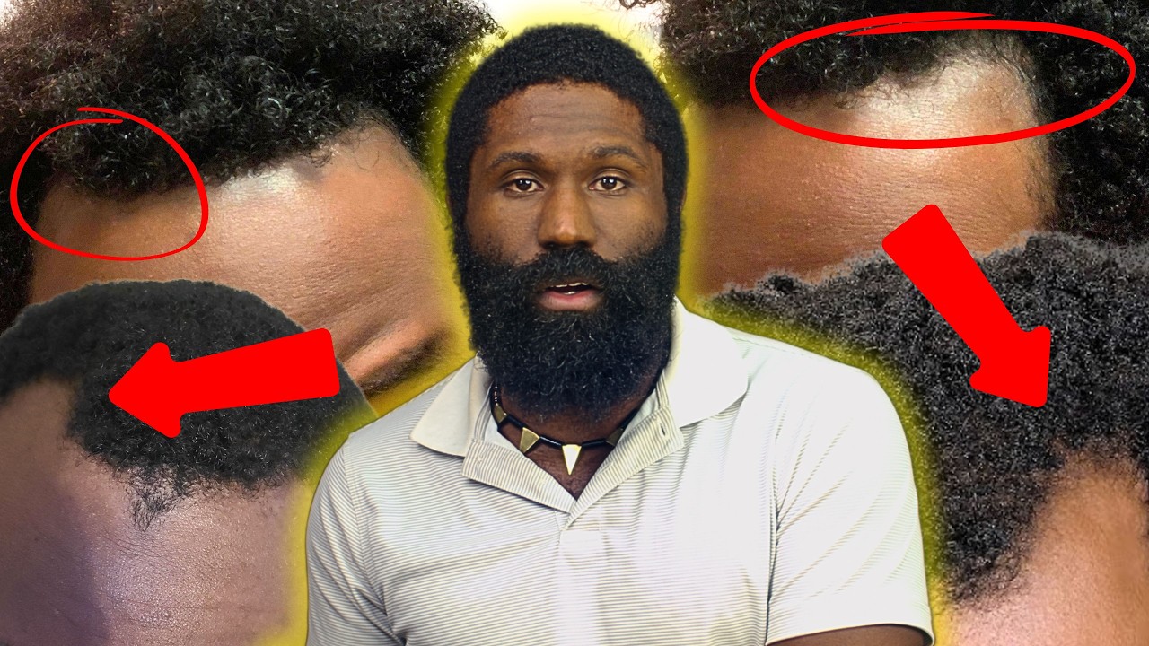 6 Common Causes of a Receding Hairline & How to Reverse Hair Loss Naturally | Hair Growth Tips