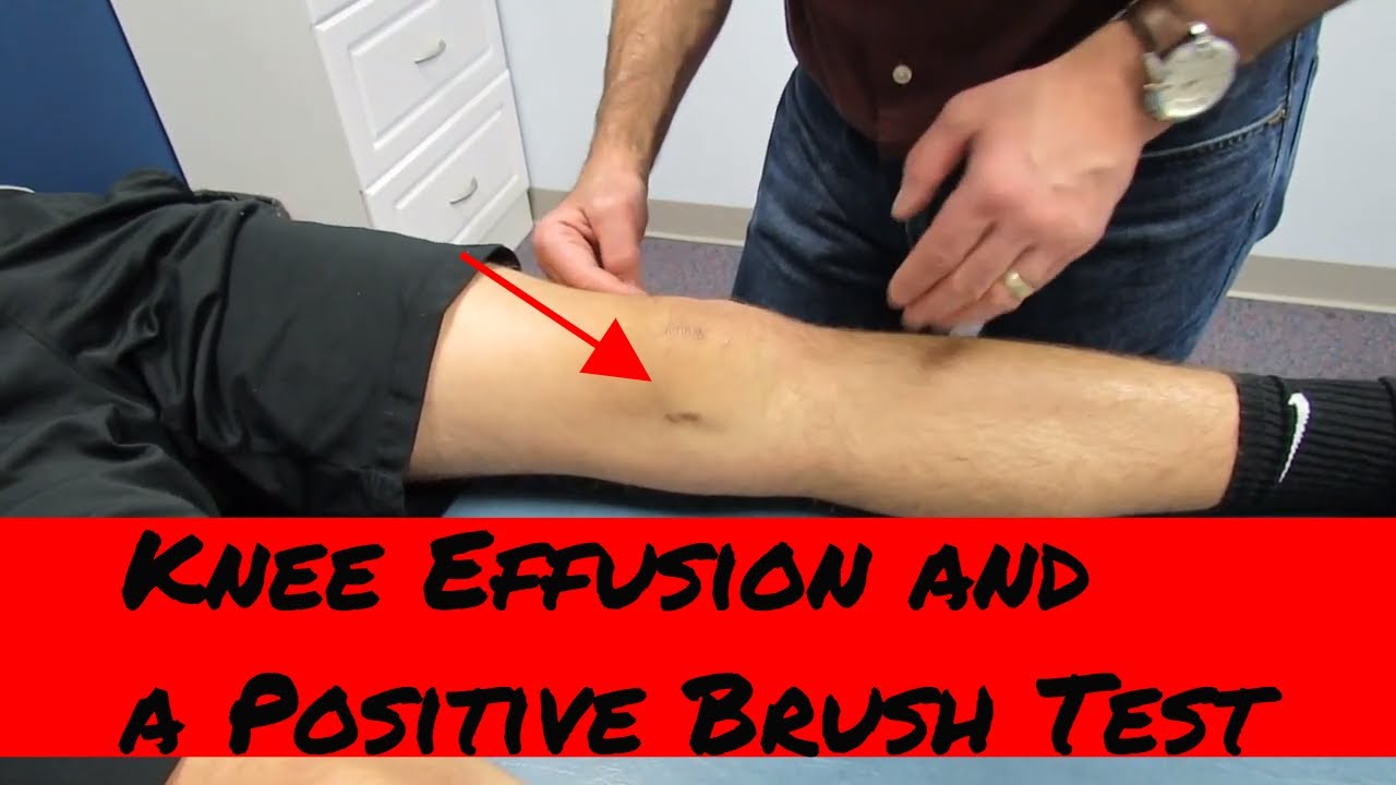 Knee effusion, positive brush test and intra-articular knee injury eval