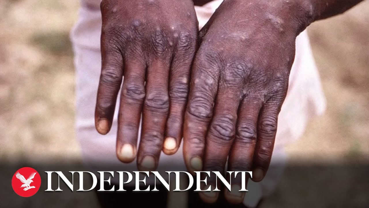 Monkeypox: How does the virus spread and what are the symptoms?