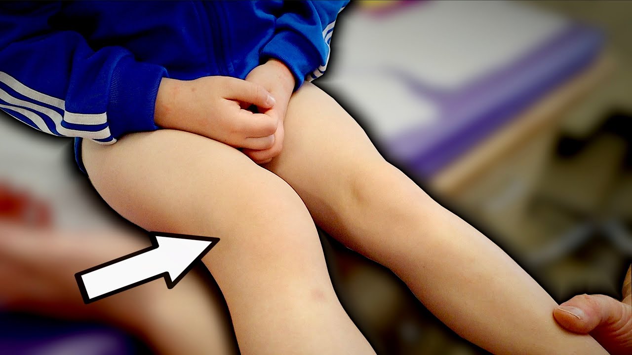 4 YEAR OLD WITH SWOLLEN & WARM KNEE YET NO INJURY... (Why?) | Dr. Paul