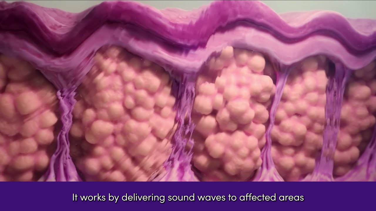 RESONIC™ | Cellulite Treatment | How it Works