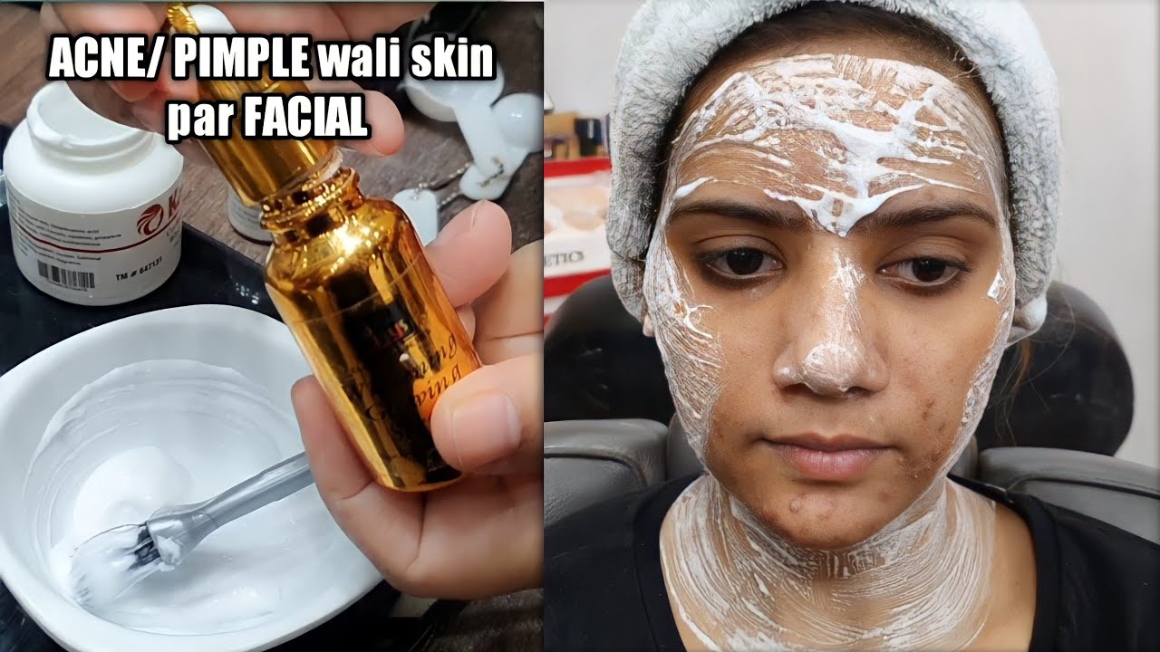 ACNE/ PIMPLE wali skin par FACIAL kare ya nahi | Best Facials for Pimples Acne prone skin