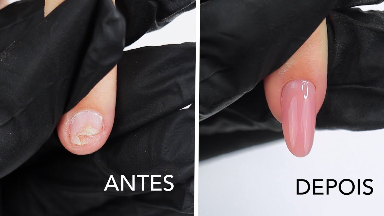 Tutorial como construir uma unha em Acrygel e Dual Form com placa ungueal danificada