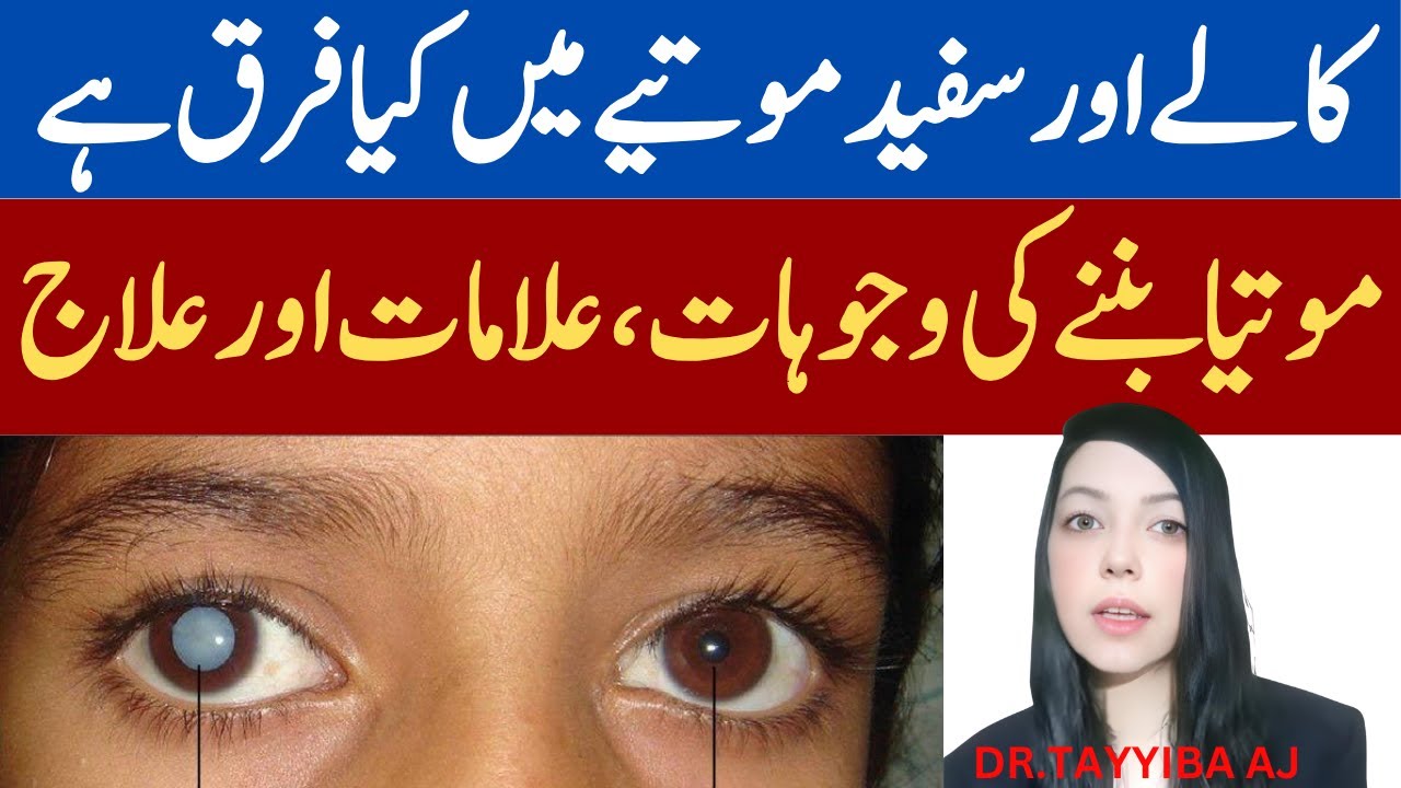 Kala or Sufaid Motia Ka ilaj & Alamat - Glaucoma and Cataract Treatment - Ankh Me Motia