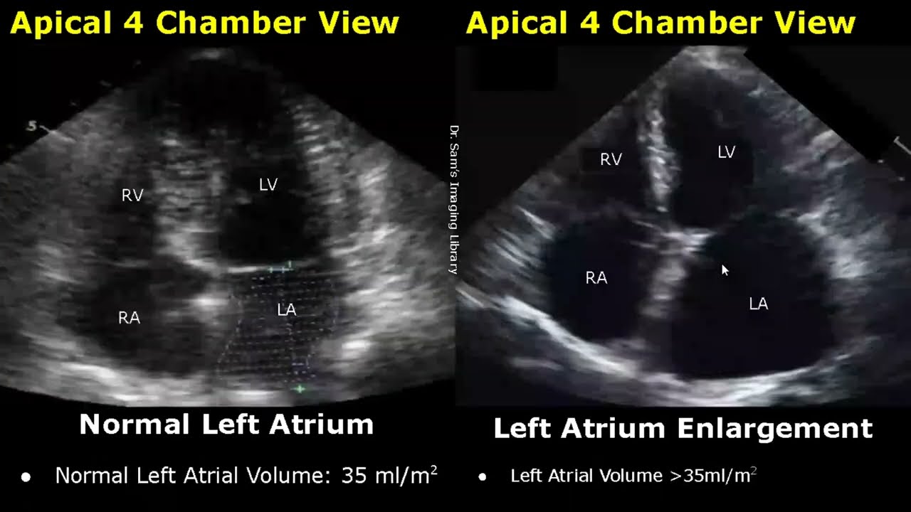 Echocardiography Normal Vs Abnormal Images | Heart Ultrasound | Cardiac Color/Spectral Doppler USG