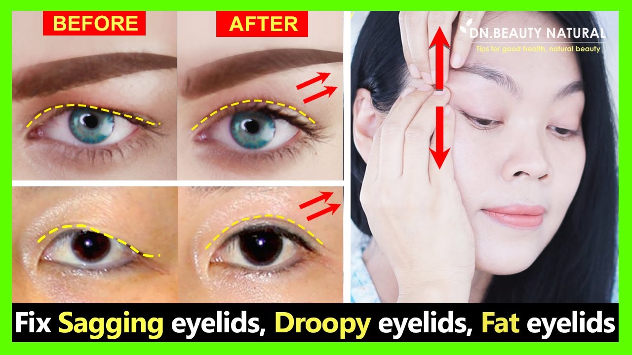 Get Big eyes view and natural Double eyelids. Fix sagging eyelids, droopy eyelids and fat eyelids.