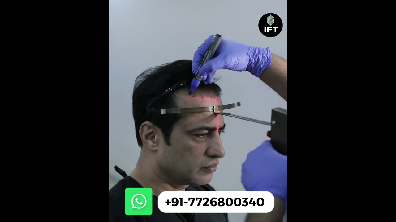 Diya Bati IPS fame Aryan Harnot hair transplant I Celebrity hair transplant #celebrityhairtransplant